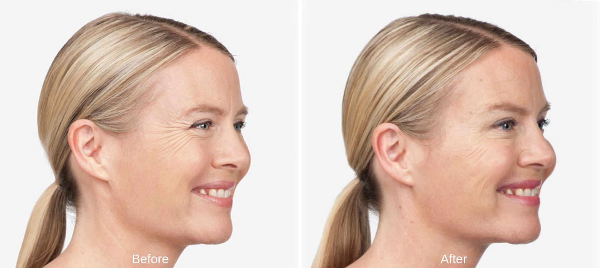 Womans before and after results from Botox.
