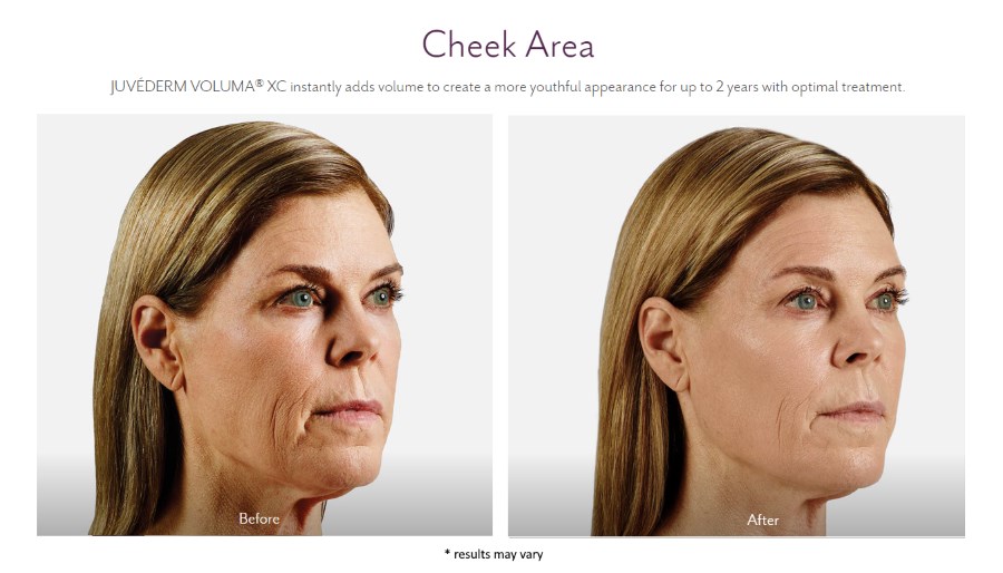 Womans before and after results from juvederm treatment to the cheek area.