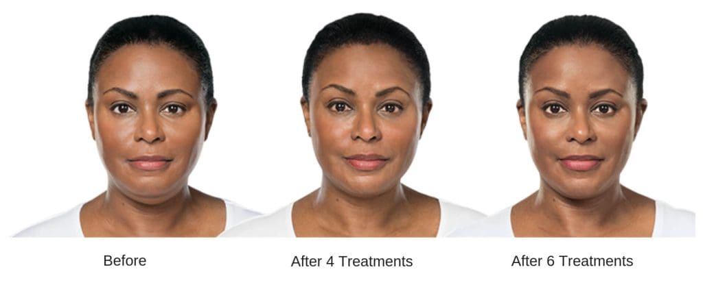 Womans before and after results from Kybella.