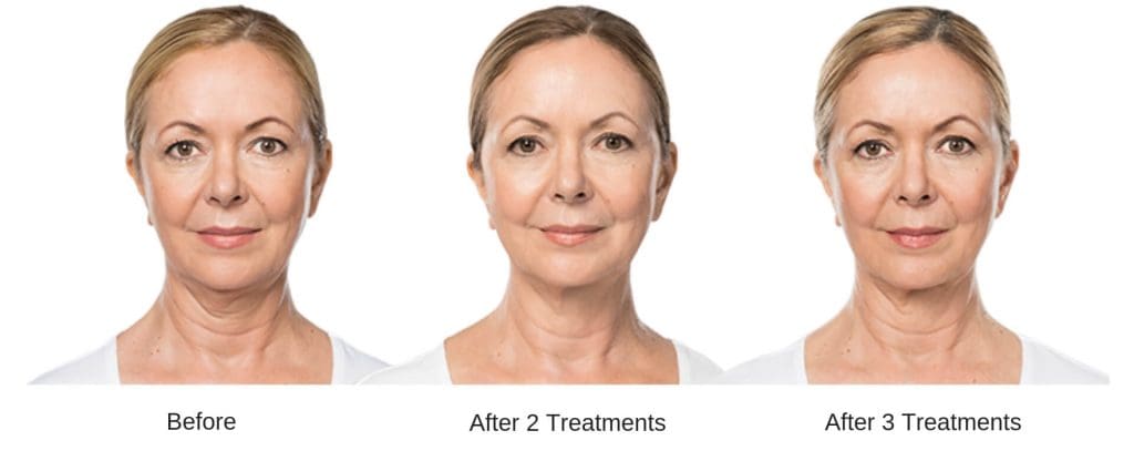 Womans before and after results from Kybella.