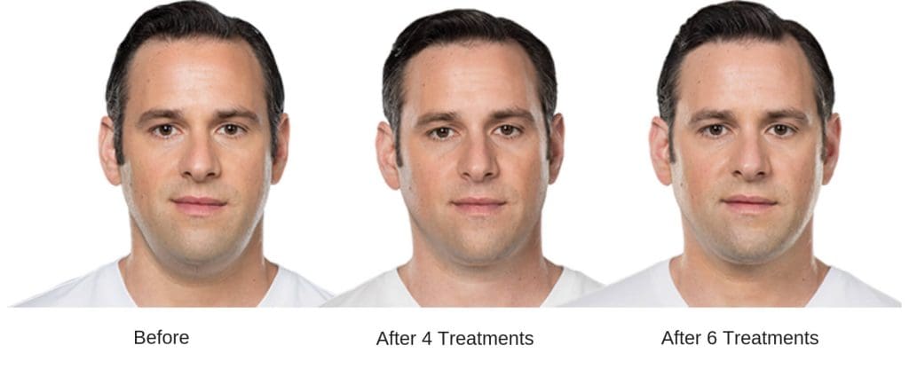 Mans before and after results from Kybella.
