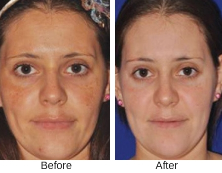Woman's before and after results from microneedling treatment at shore medical aesthetics.