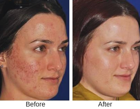 Woman's before and after results from microneedling treatment at shore medical aesthetics.