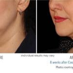 coolsculpting before and after double chin woman