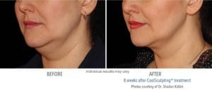 coolsculpting before and after double chin woman