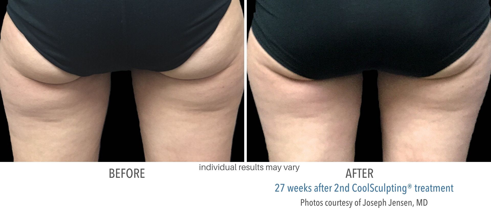 coolsculpting before and after buttocks