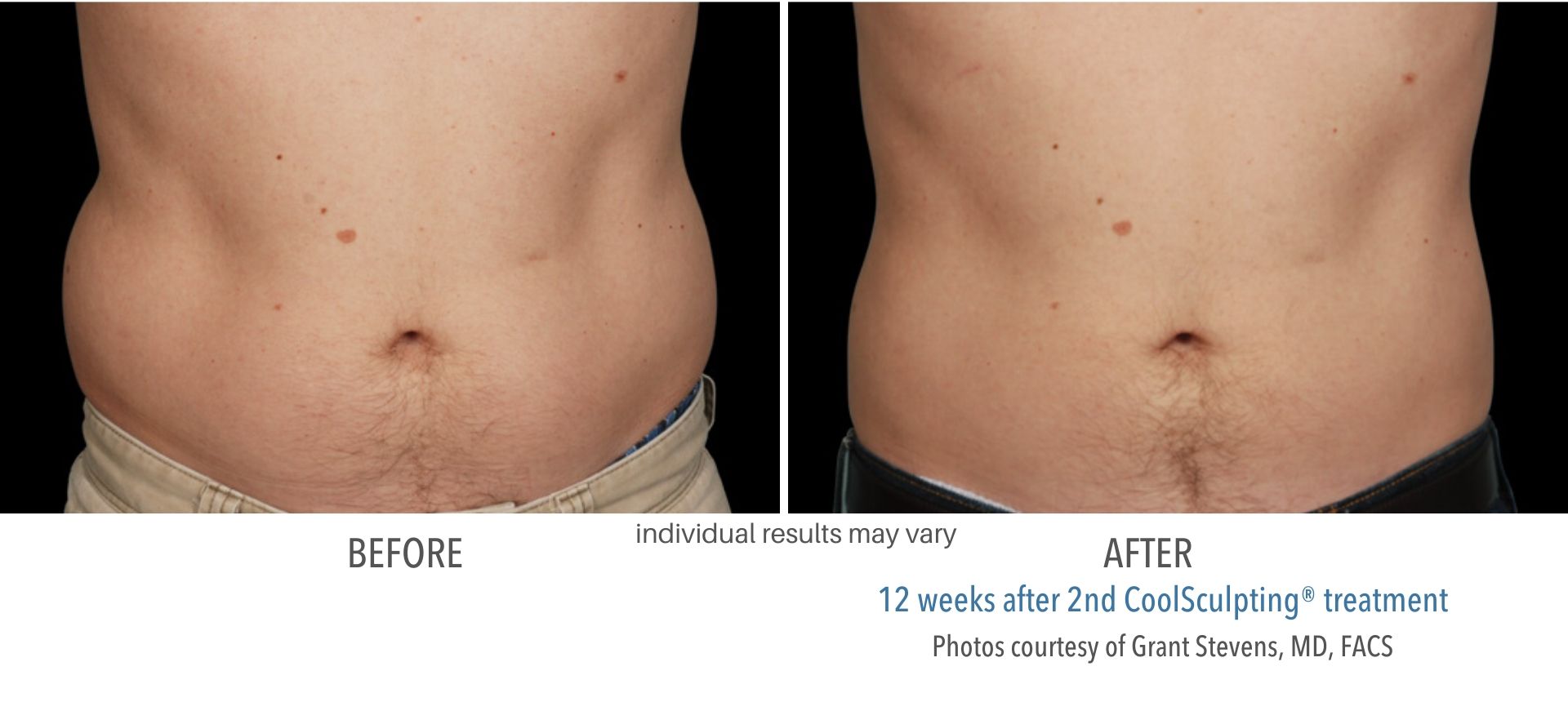 coolsculpting before and after stomach man