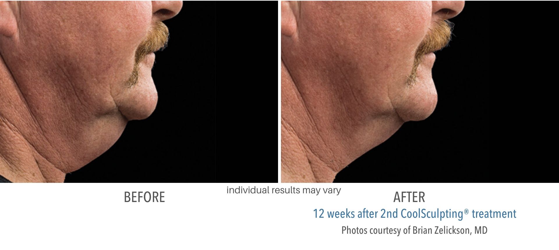 coolsculpting before and after double chin man