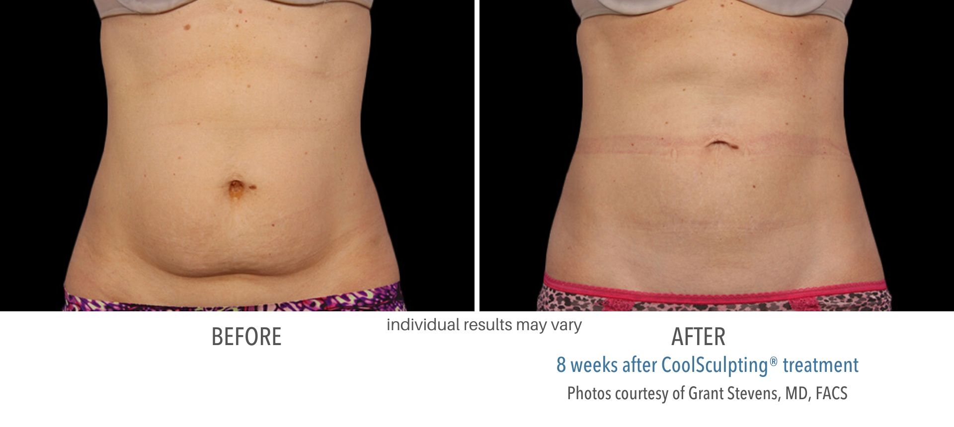 coolsculpting before and after abdomen