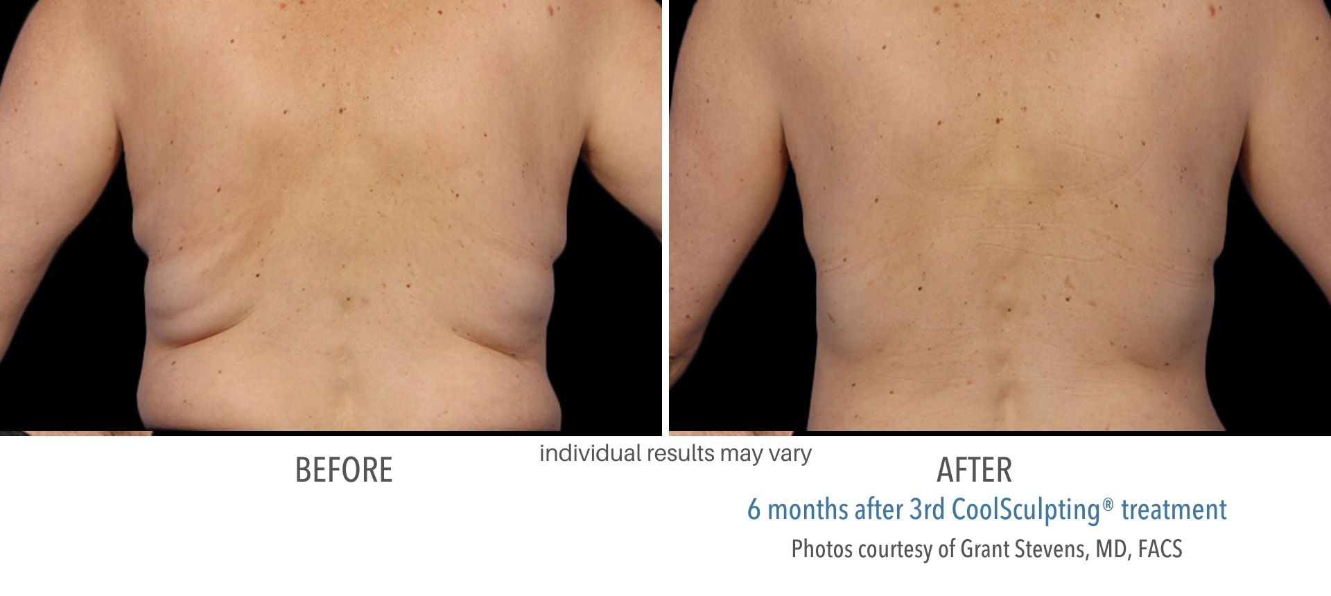 coolsculpting before and after back