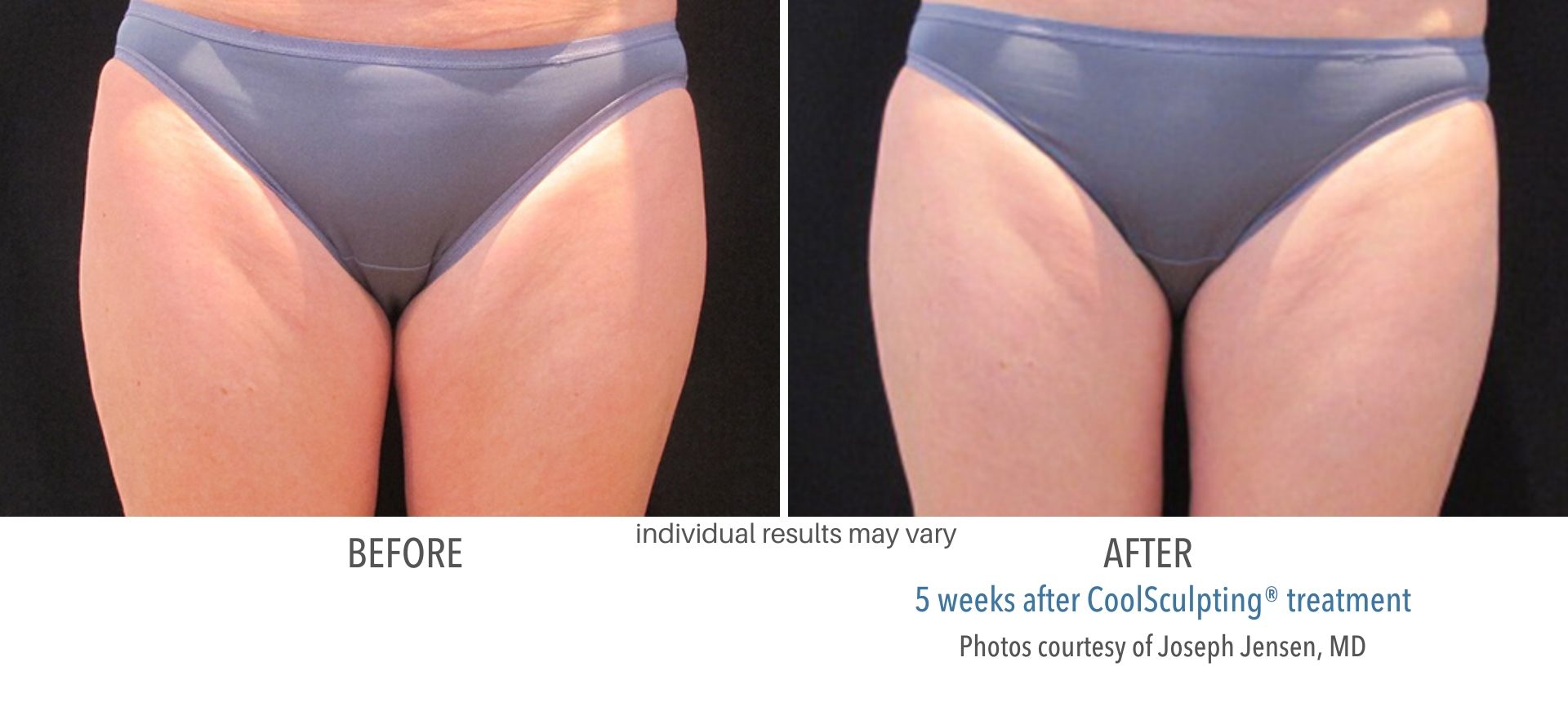 coolsculpting before and after inner thigh