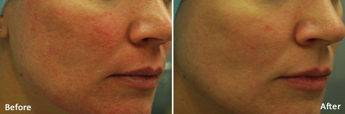 Morpheus 8 Skin Tightening before and after treatment in Huntington, NY