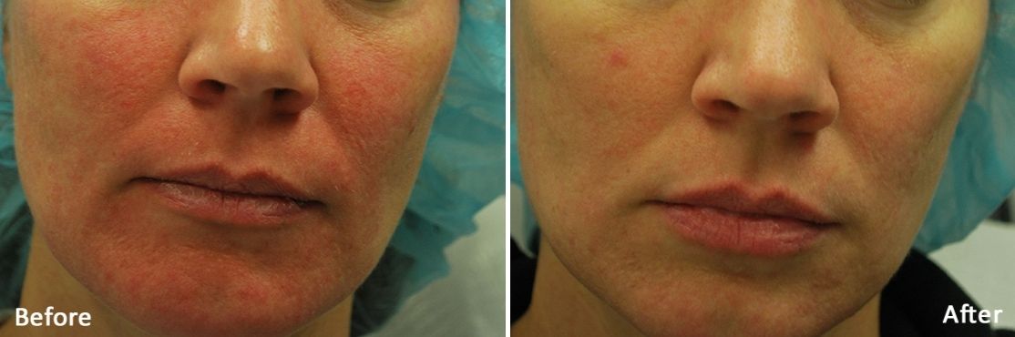 Morpheus 8 RF Microneedling treatment result in Shore medical aesthetics, before & after.