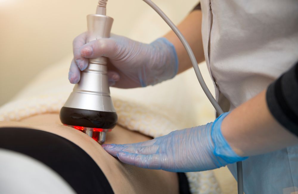 What is Laser Liposuction?